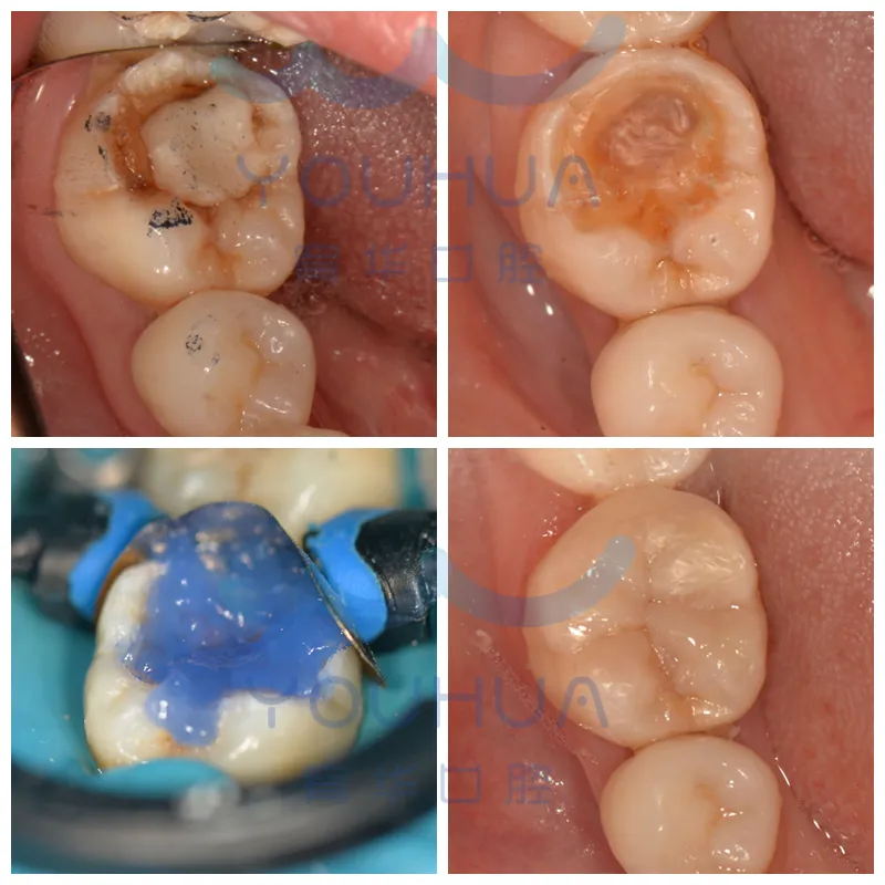 赖女士的蛀牙：不做根管也能好