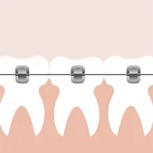 传统金属托槽矫正