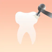 牙齿抛光、喷砂深层洁牙