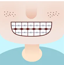 乳牙拔除、早期干预矫正