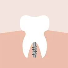 单颗/多颗种植牙