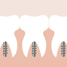 全口/半口种植修复